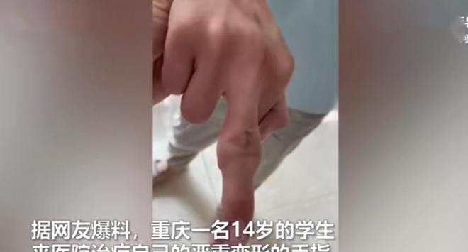 TVT体育官方网站三起因吃而导致的问题：14岁重庆男生因奶茶等垃圾食品而手指变形(图1)